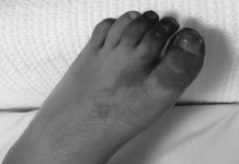 After his toes turned black, doctors were alarmed